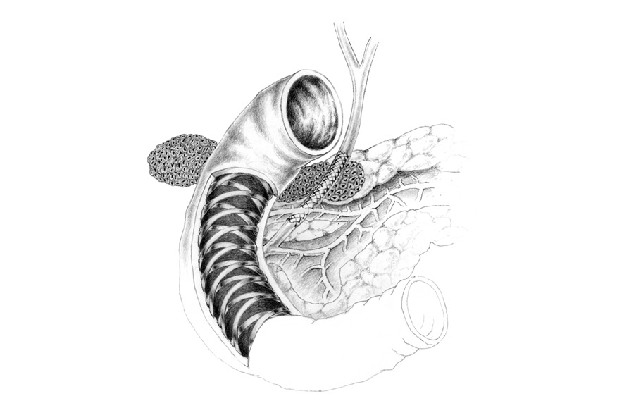 Pancreas, duodenum & metal stent. Education resource. Pencil.